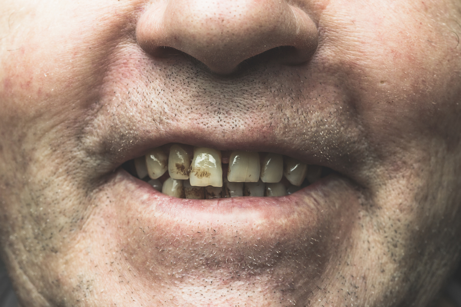 smokers teeth emergency dental service blog