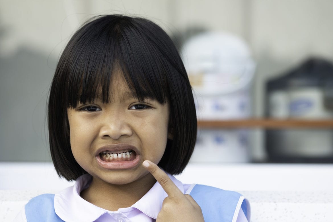 toddler with tooth decay