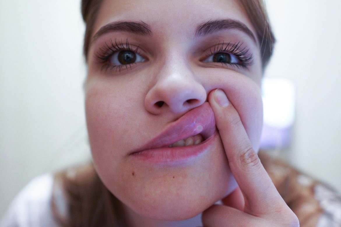 blog-eds-whitesSPOT Woman holding her upper lip