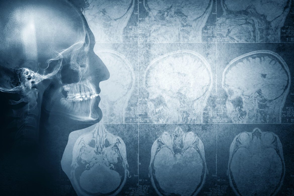 blog-eds-brainhealth-cavity Dental and brain health