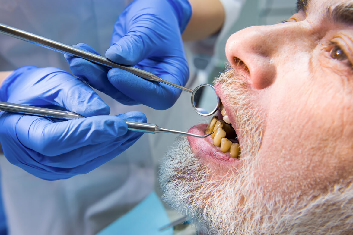An elderly man with poor teeth is getting dental work done.